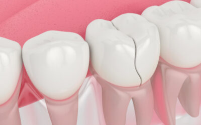 Dental Fillings: What They Are and Why You Might Need Them