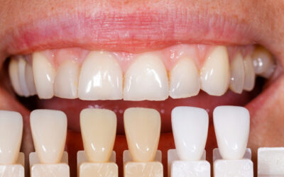 Everything You Need to Know about Dental Veneers in Dallas, TX