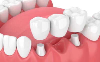 What Types of Dental Bridges Work Best?