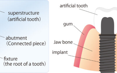 Dental Implants: History, How They Work, Candidacy Requirements, and More!