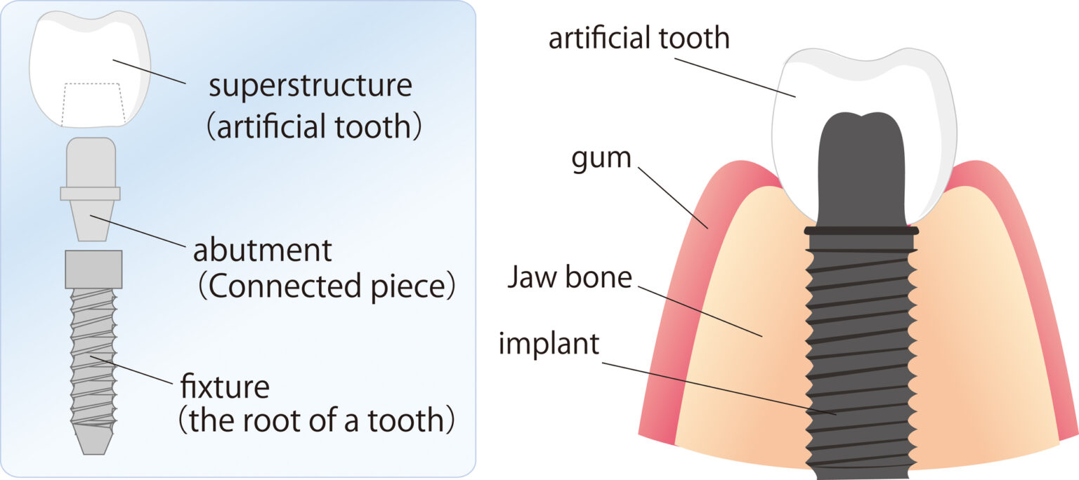 Diagram displaying the components of a dental implant used in Texas dentistry, with labeled parts including the artificial tooth, abutment, fixture, gum, and jaw bone implant.